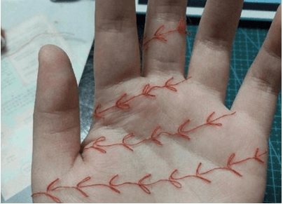 Imagen de las redes sociales chinas publicada por Daily's Peope en las que se ve cómo se han cosido las manos.