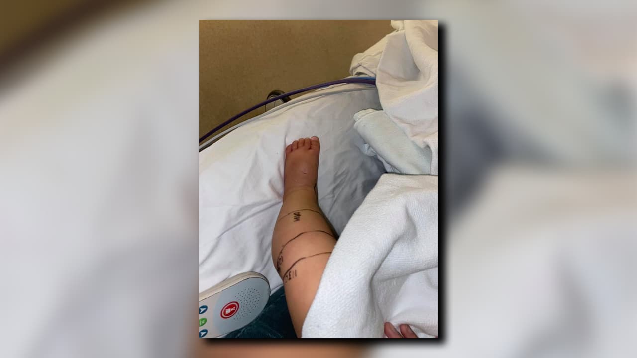La piernita de Emma aún presentaba hinchazón y hematomas.