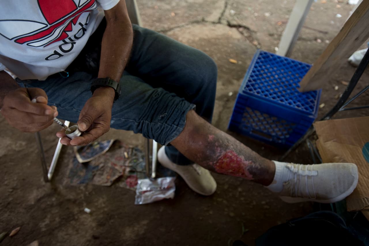La pierna de este adicto está infectada por el uso repetido de jeringas con cocaína, según cuenta el hombre que confiesa que ahora usa heroína.