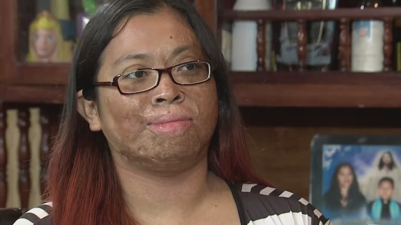 La vida le regaló el milagro de sobrevivir a una terrible explosión pero ahora necesita ayuda para seguir adelante