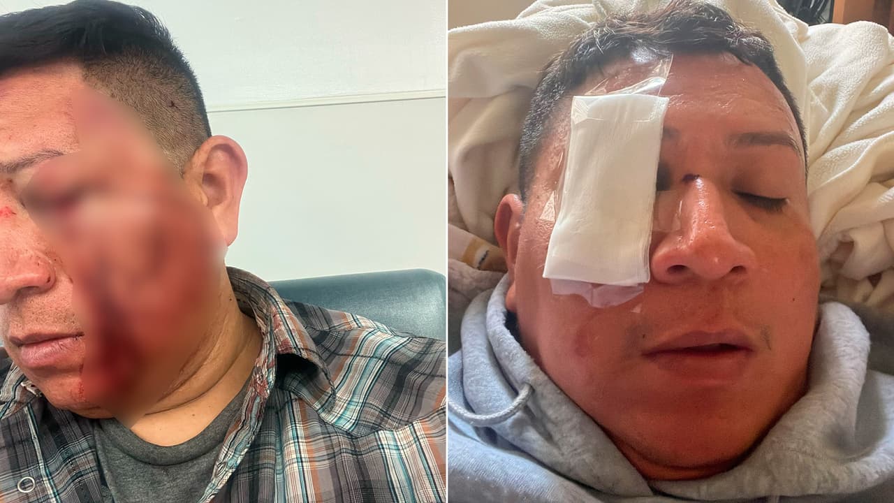 Javier Ibarra sufrió fracturas faciales, una laceración ocular y múltiples contusiones