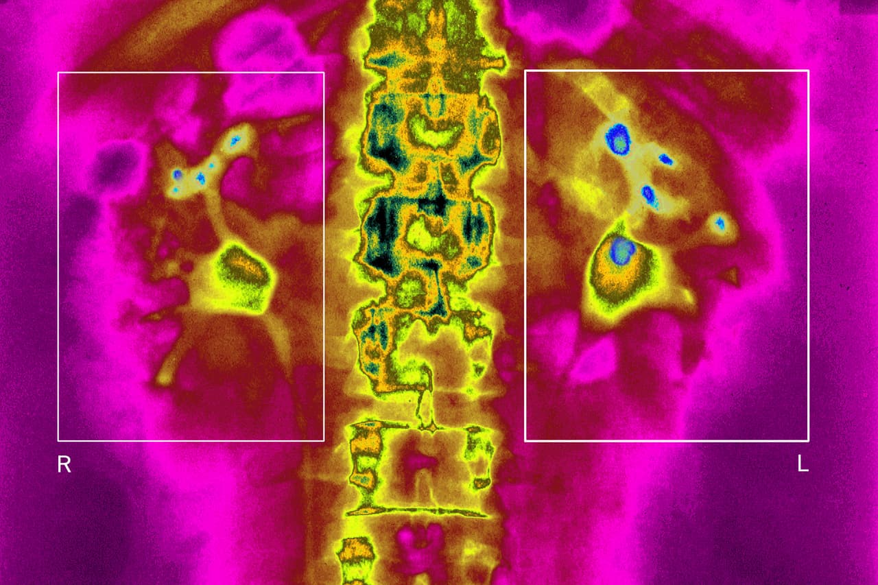 <b>Enfermedad renal crónica</b>