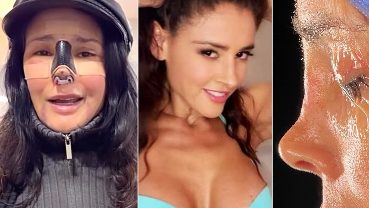 Dorismar muestra “cicatriz irreversible” en su nariz al presentar “necrosis” tras una mala cirugía