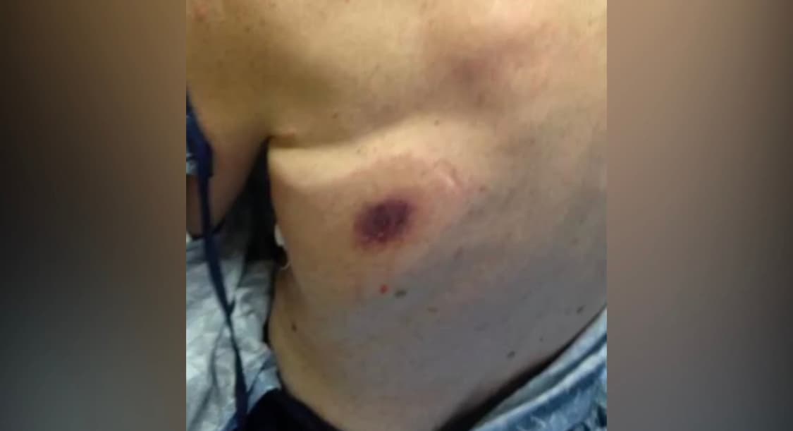 Lo llevaron al hospital y “vieron una mancha negra terriblemente hinchada en su espalda que no estaba allí antes”, aseguró Cheryl. El hombre estuvo en terapia intensiva y posteriormente murió.