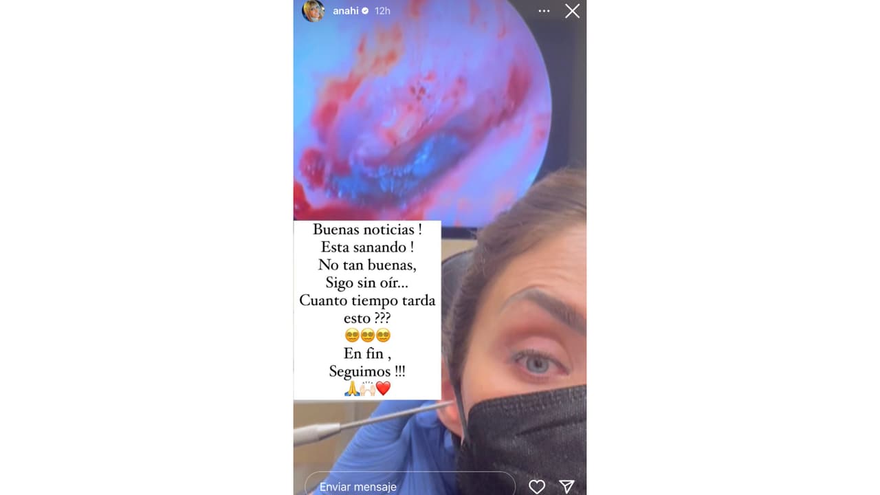 Anahí muestra cómo está su oído tras perforación de tímpano.