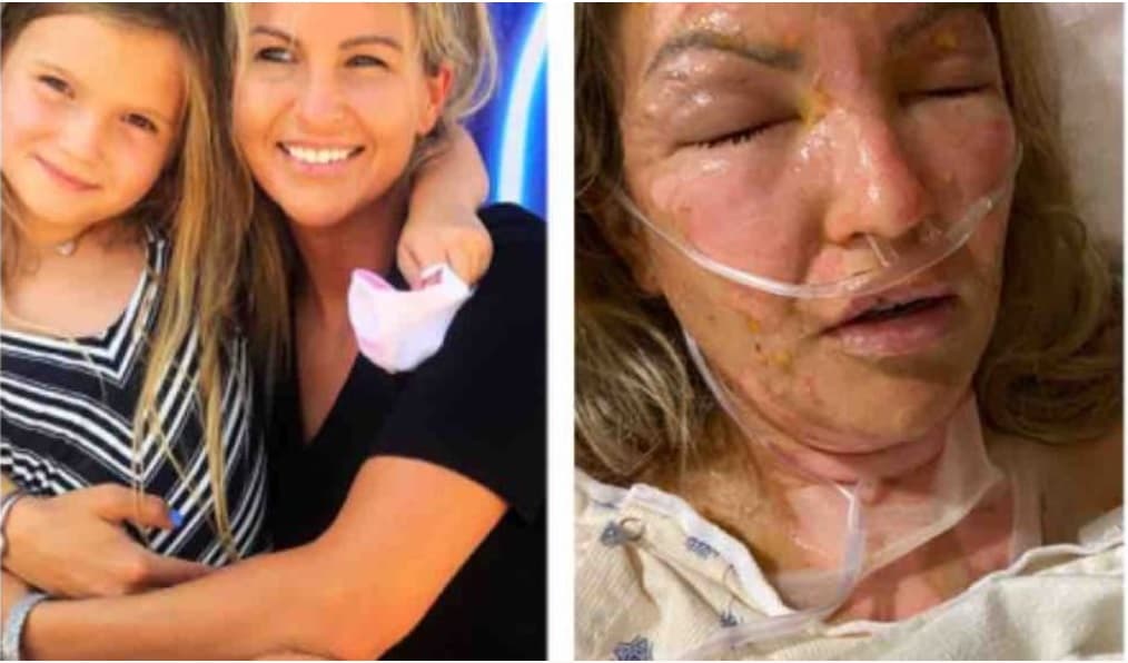 "Mi cuerpo se consumió en llamas": una mujer sufre graves quemaduras tras encender una vela después de haberse aplicado desinfectante en las manos