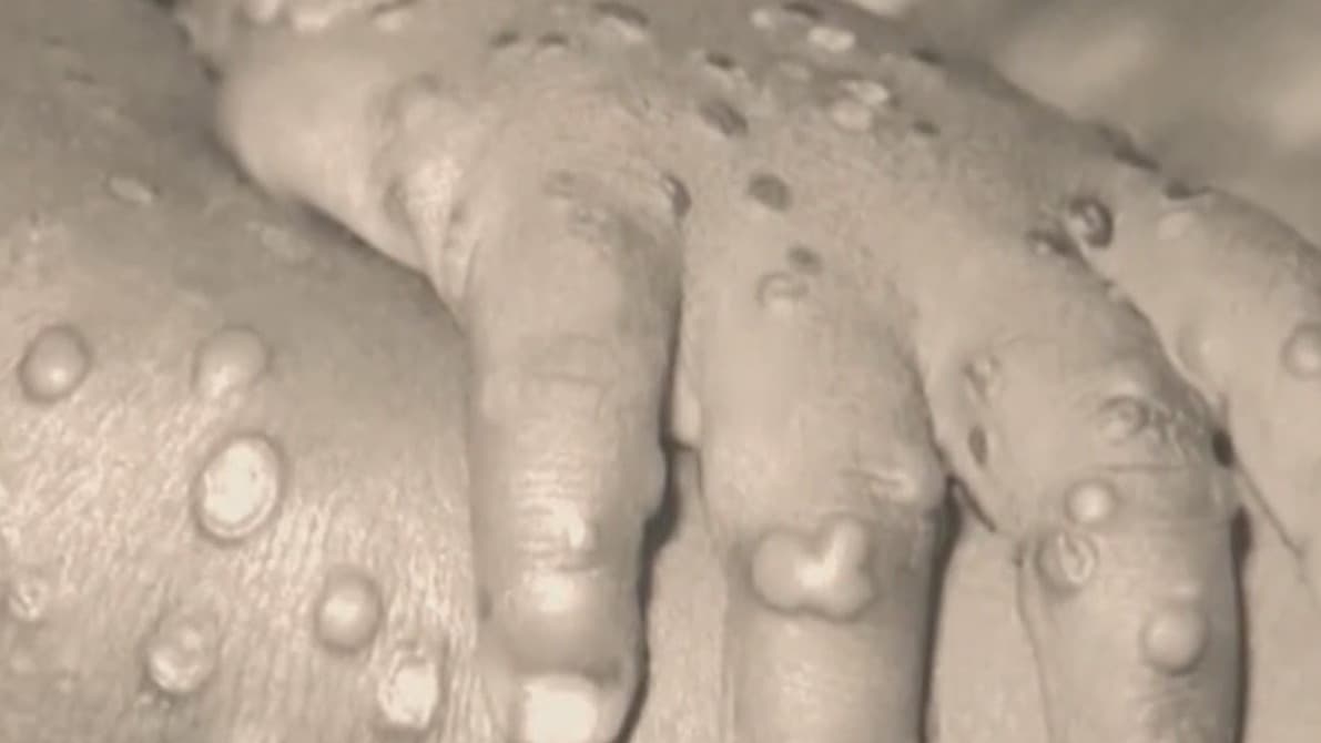 Autoridades distribuyen vacunas contra la viruela de mono en San Antonio 