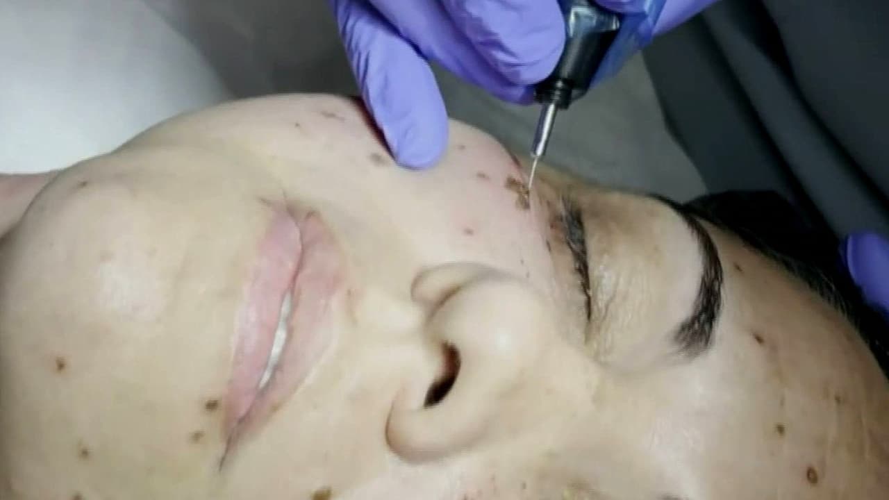 Lifting facial sin cirugía, ni bisturí ¿la tecnología actual como secreto de belleza?