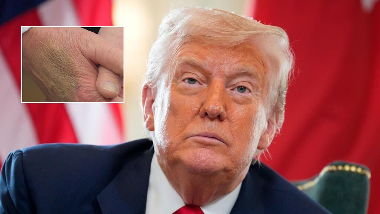 Trump dice que los moretones en sus manos son por un consumo elevado de aspirina: las noticias del día