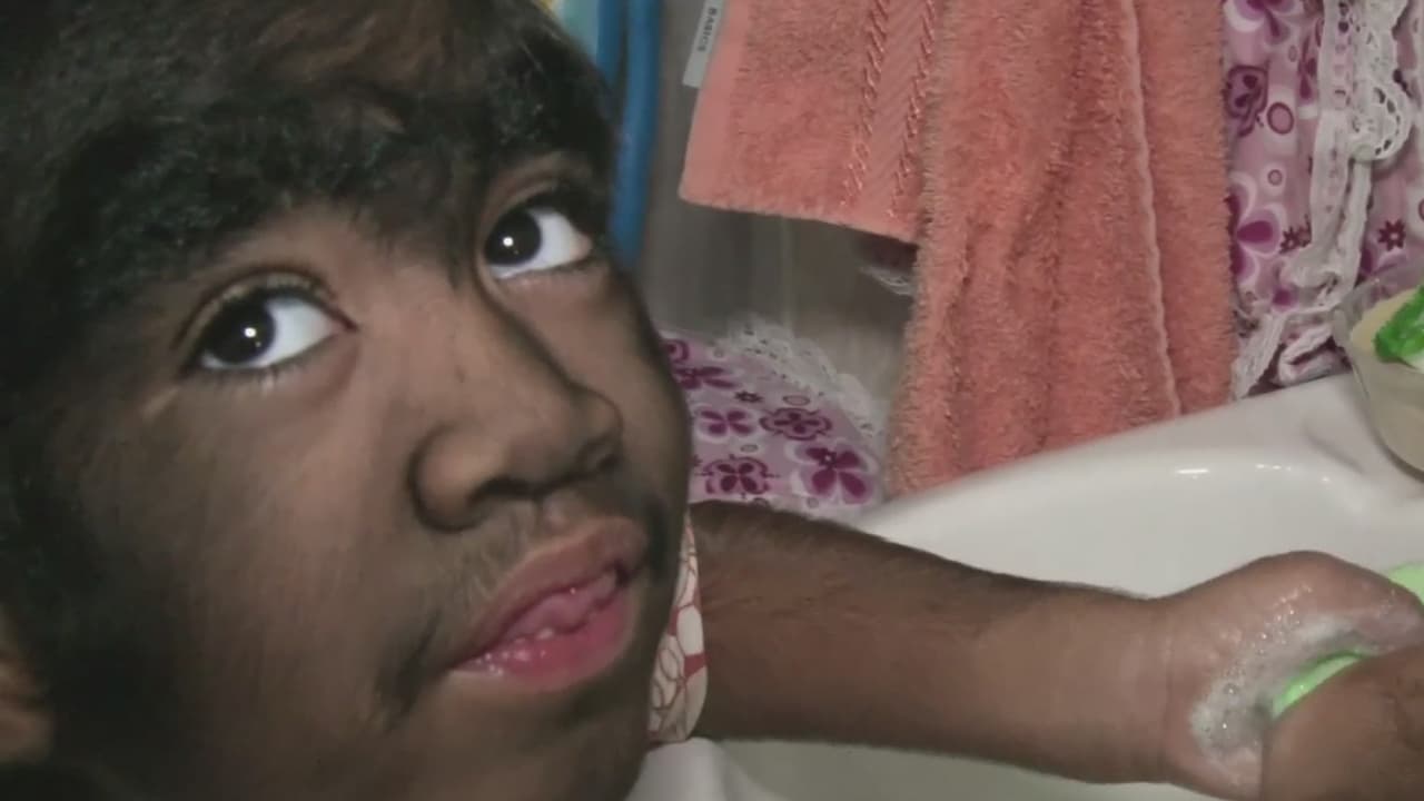 Nació con el cuerpo cubierto de pelos y su angustiada familia pide que no lo llamen más 'el niño lobo'