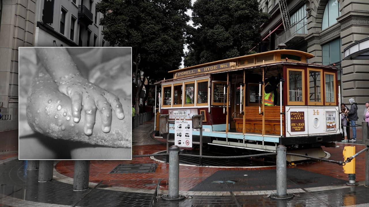 San Francisco reporta el primer caso probable de viruela del mono en el Área de la Bahía