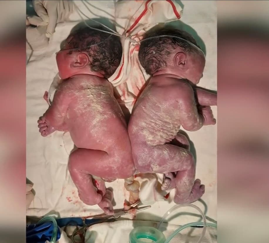 A pesar de que los exámenes médicos no mostraron ningún problema, la cesárea mostró varias complicaciones y la doctora encargada del parto
<b>se dio cuenta que los bebés estaban pegados. </b>
<br>