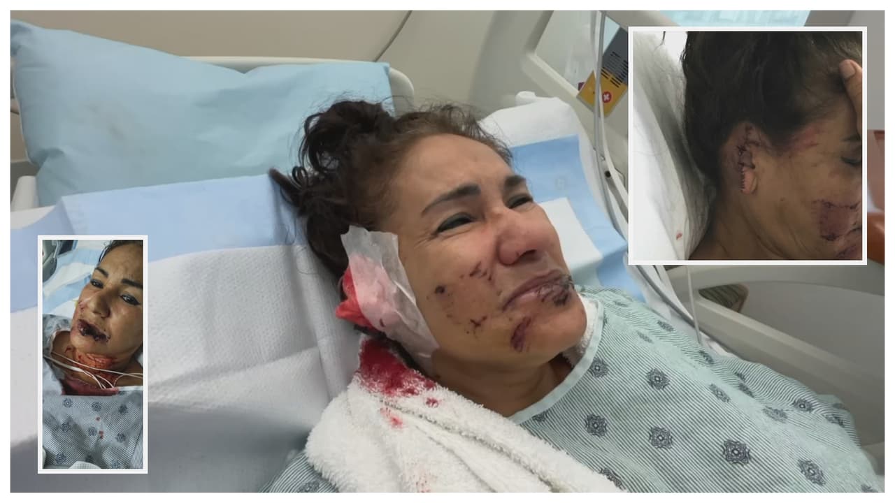 Perros arrancan la oreja, desfiguran parte del rostro y muerden el cuerpo a una mujer en Miami