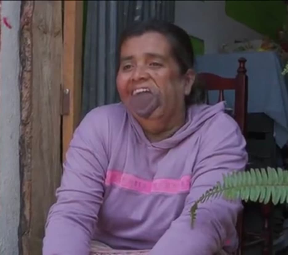 No era la primera vez que Hernández sufría este tipo de rechazos brutales. La guatemalteca de 40 años rememora que cuando iba a trabajar le cerraban la puerta en la cara porque
<b> “era un fenómeno con boca de sapo”. </b>
<br>