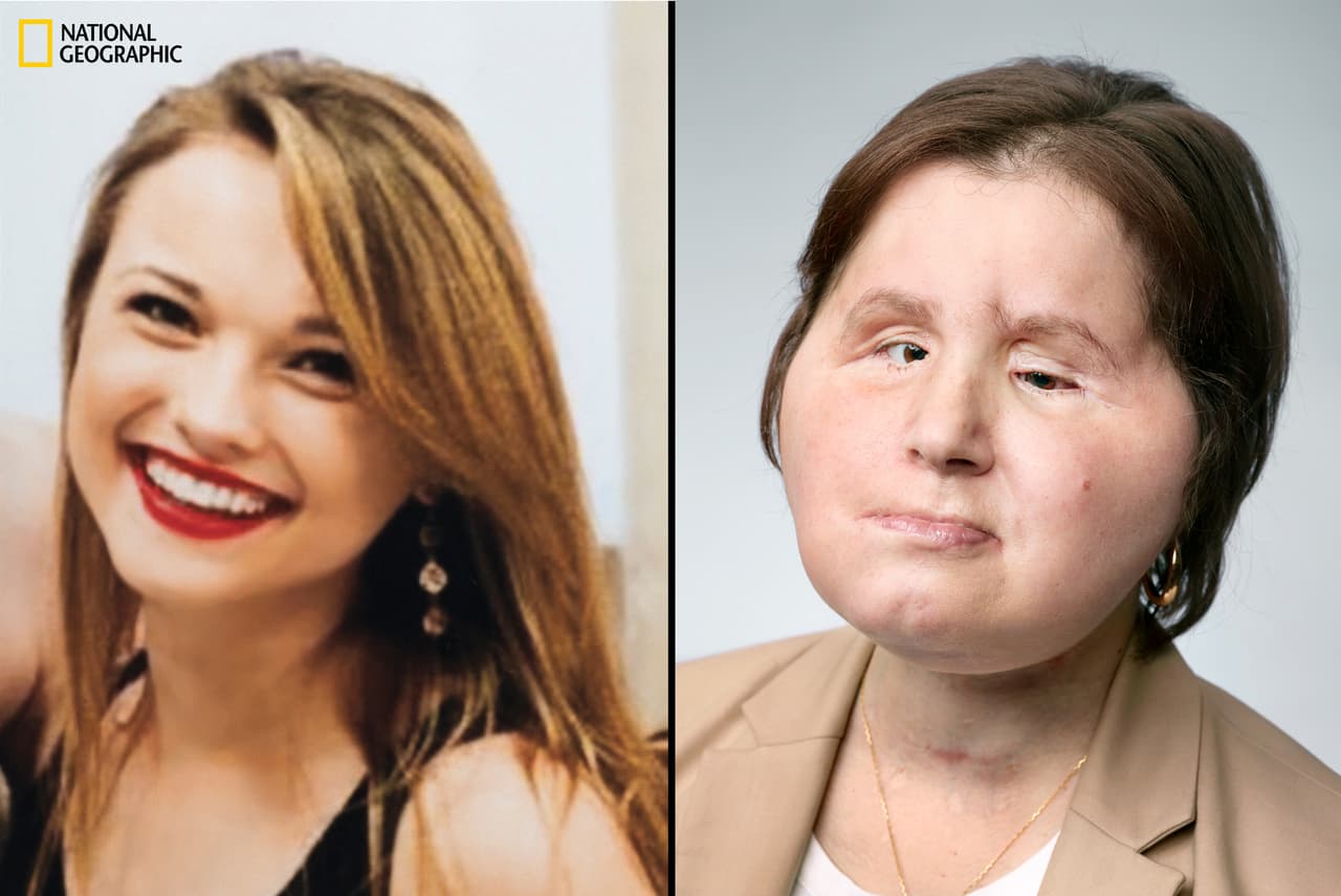 A la izquierda, Katie Stubblefield, de 17 años, 8 meses antes de intentar suicidarse. En la foto de la derecha, Katie, de 22 años, un año y un mes después de su cirugía.
