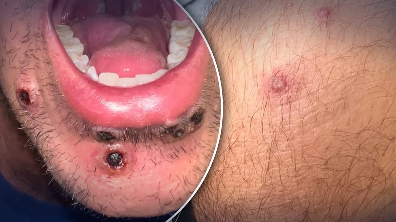 Suman más de 400 casos de viruela del mono en el norte de Texas