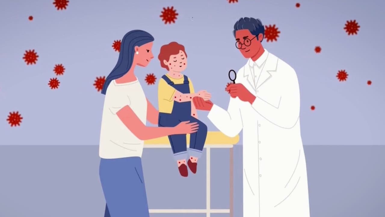 Sarampión en Florida: qué síntomas provoca y cómo recomiendan proteger a los niños