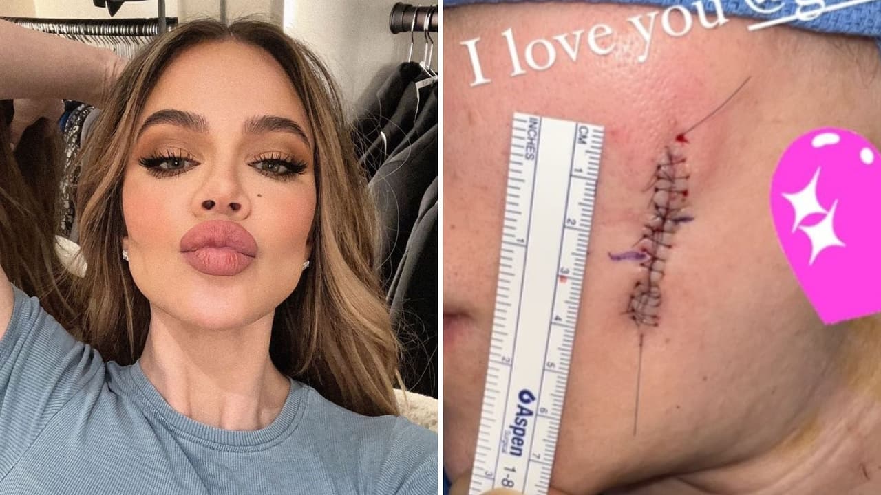 Khloé Kardashian muestra “la hendidura” en su mejilla tras extirpación de un melanoma
