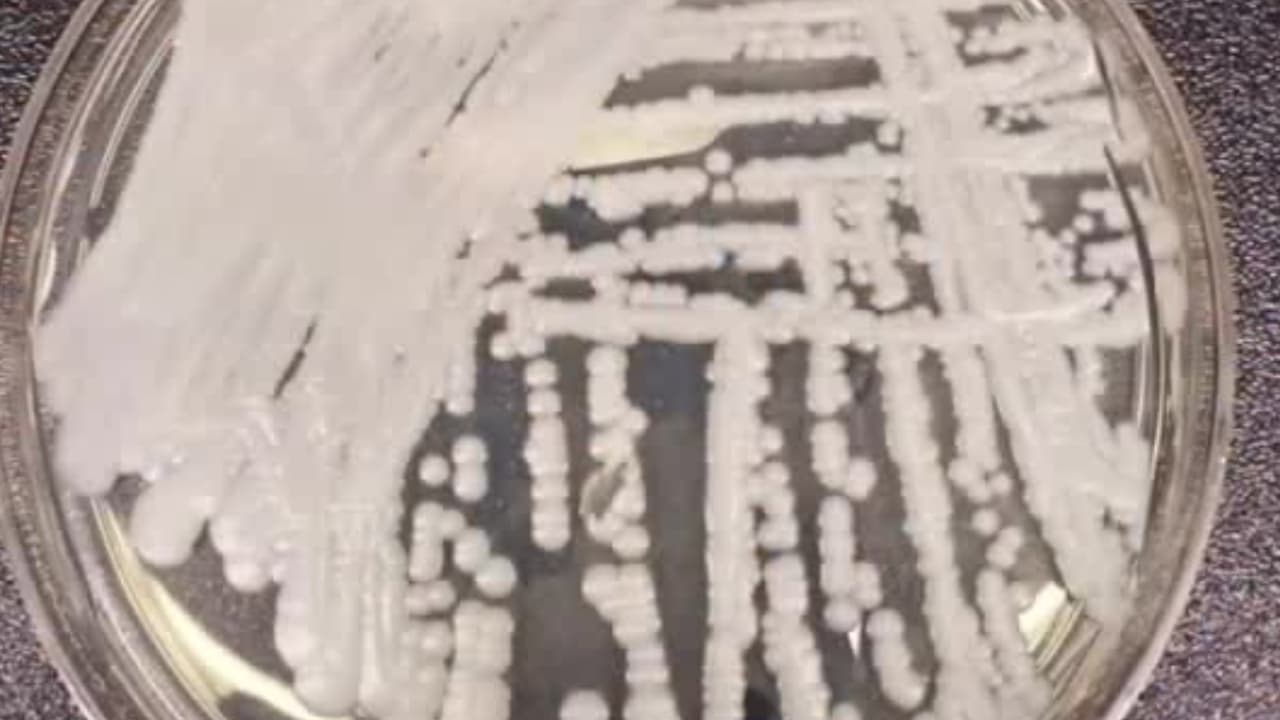 Un hongo mortal y resistente a medicamentos se propaga con rapidez en EEUU: hay 27 estados afectados