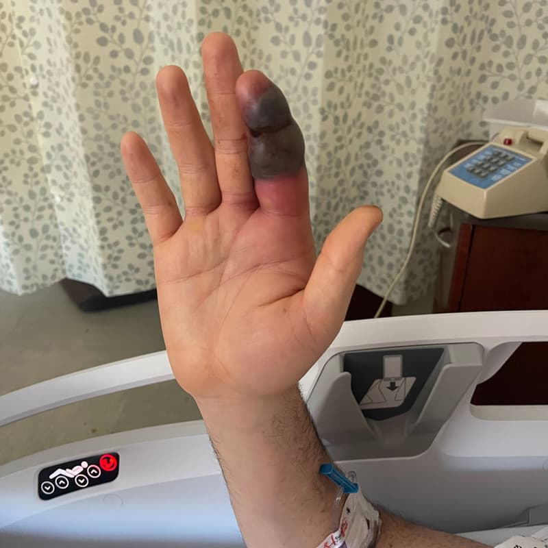 Un ciclista fue mordido por una serpiente copperhead en Palisades cuando intentó moverla del sendero para evitar que fuera atropellada. El incidente requirió tratamiento especializado en el Hospital Universitario Hackensack, donde recibió antídoto y permaneció dos días bajo observación médica.