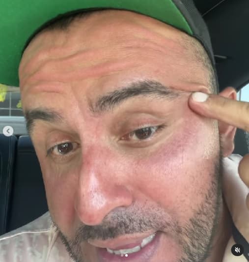 De acuerdo con Mayo Clinic, dicho procedimiento estético se “utiliza para tratar las arrugas, lo cambios de color en la piel y las cicatrices”, y que por lo general se realiza en la cara.
<br>