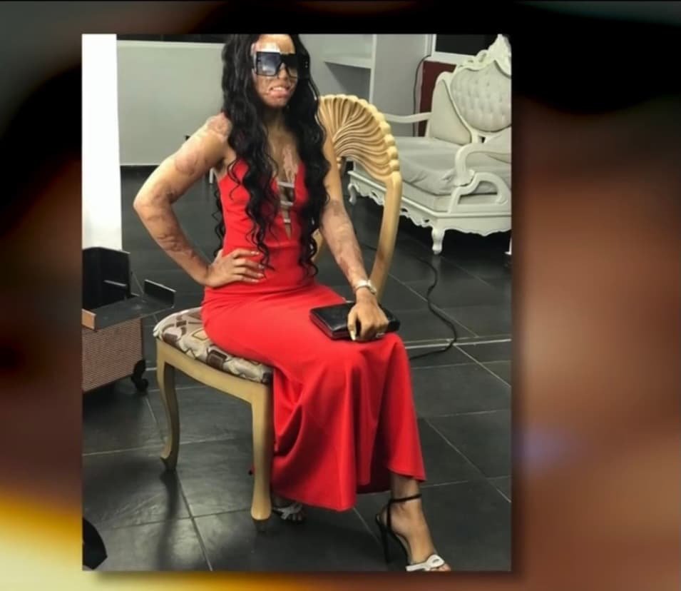 Ahora, con su agresor a punto de ser enviado a prisión, Yocayri 
<b>ha decidido no dejarse vencer por la adversidad</b> y en 
<a href="https://www.univision.com/temas/redes-sociales">redes sociales</a> ha causado furor la forma en la que se muestra bailando, posando y siendo feliz con sus imperfecciones. 
<br>