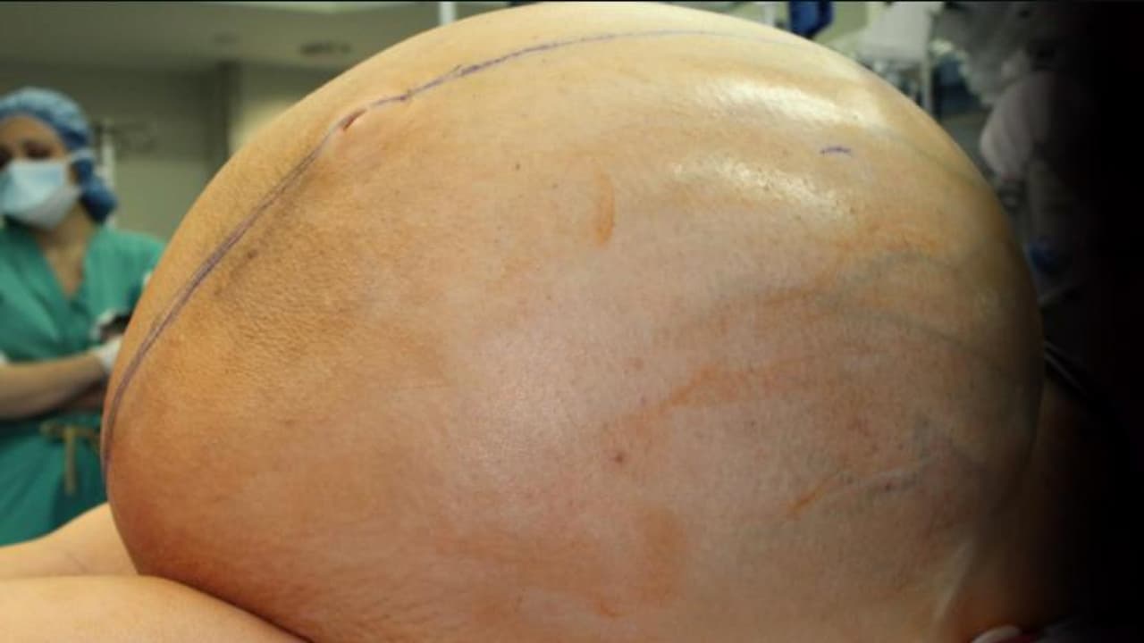 Extirpan un tumor de 132 libras a una mujer de Connecticut