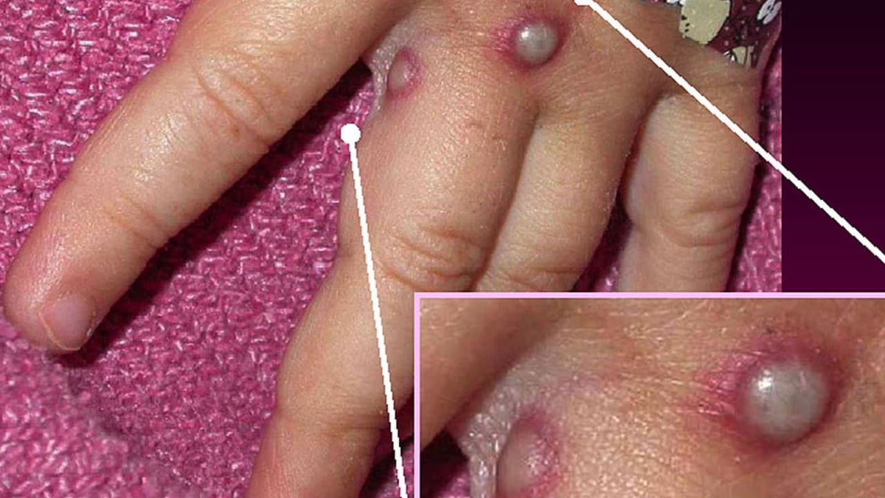 Confirman otro caso de la viruela del mono en la bahía de Tampa