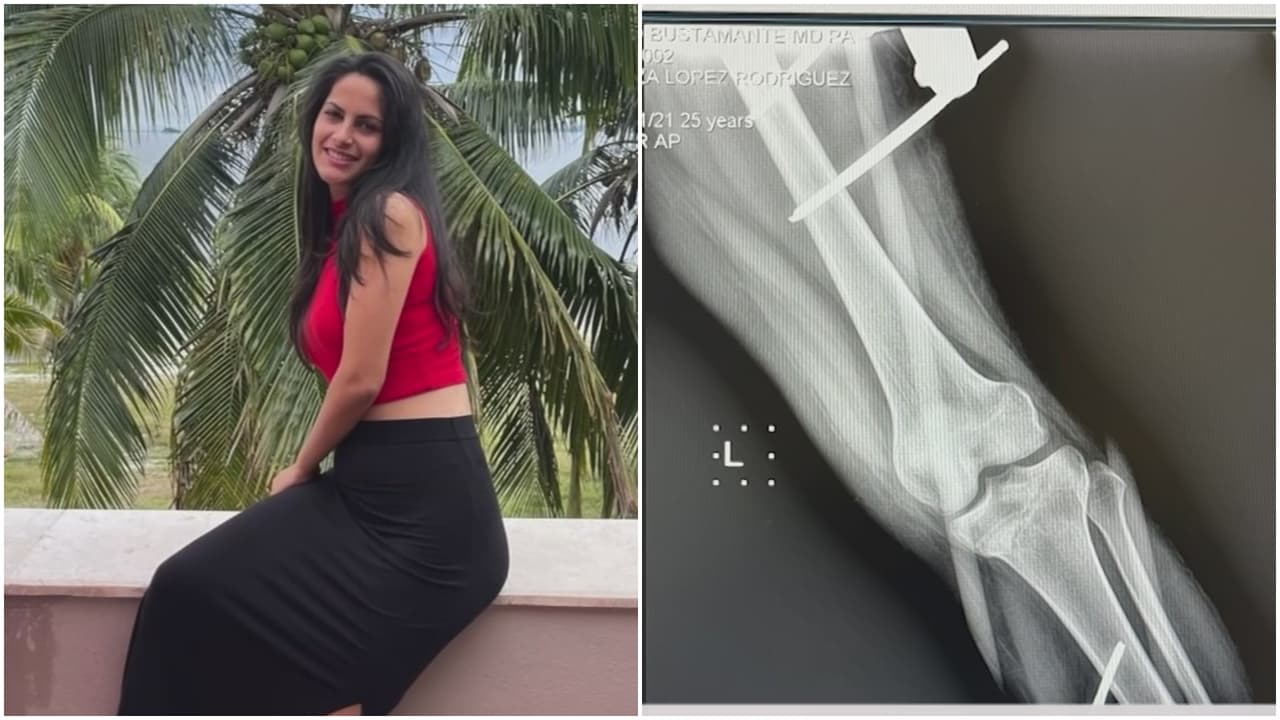 Cubana dice que Patrulla Fronteriza la golpeó y la dejó sin caminar: “Sentí como mi rodilla se quebró”