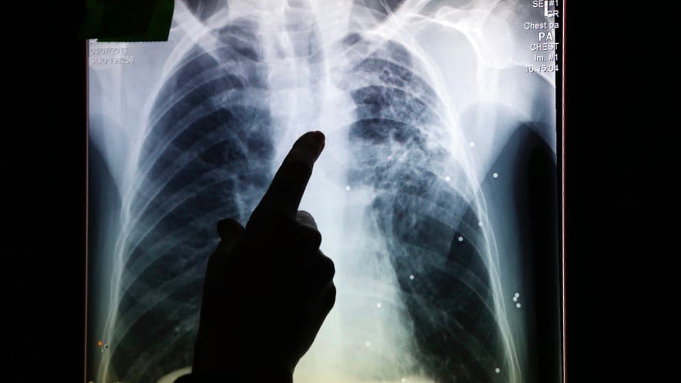 Vinculan brote de tuberculosis a productos quirúrgicos distribuidos en siete estados