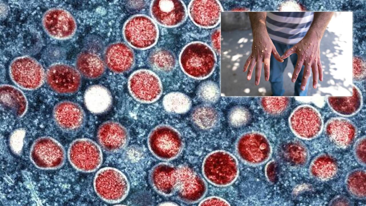 Así se transmite la viruela del mono, que suma más de 1,700 casos en California