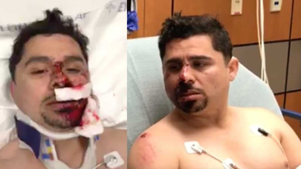 A consecuencia de este accidente, el cantante sinaloense requirió de tres cirugías y resultó con varios dientes rotos y desprendimiento del pómulo. Hacía poco más de un año que Larry se había arreglado la dentadura.