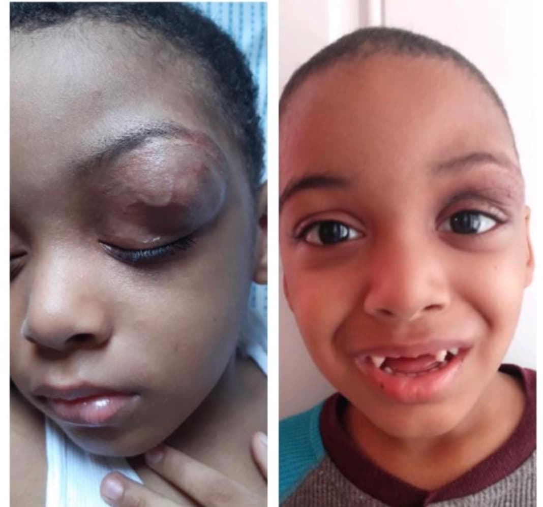 Niño dominicano logra viajar a NYC para operarse un tumor en la cabeza 