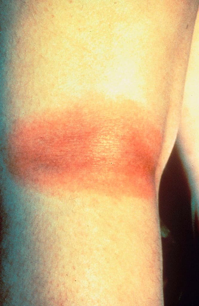 La enfermedad de Lyme es causada por la bacteria Borrelia burgdorferi y, en raras ocasiones, por Borrelia mayonii. Se transmite a los humanos a través de la picadura de garrapatas. Los síntomas típicos incluyen fiebre, dolor de cabeza, fatiga y una erupción cutánea característica llamada eritema migratorio.
<br>