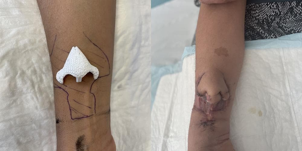 Reconstruyen en el brazo de una mujer una nariz artificial completa tras perderla por un cáncer