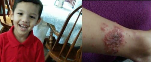 Enfermedad de piel inmoviliza por dolor a niño de 4 años