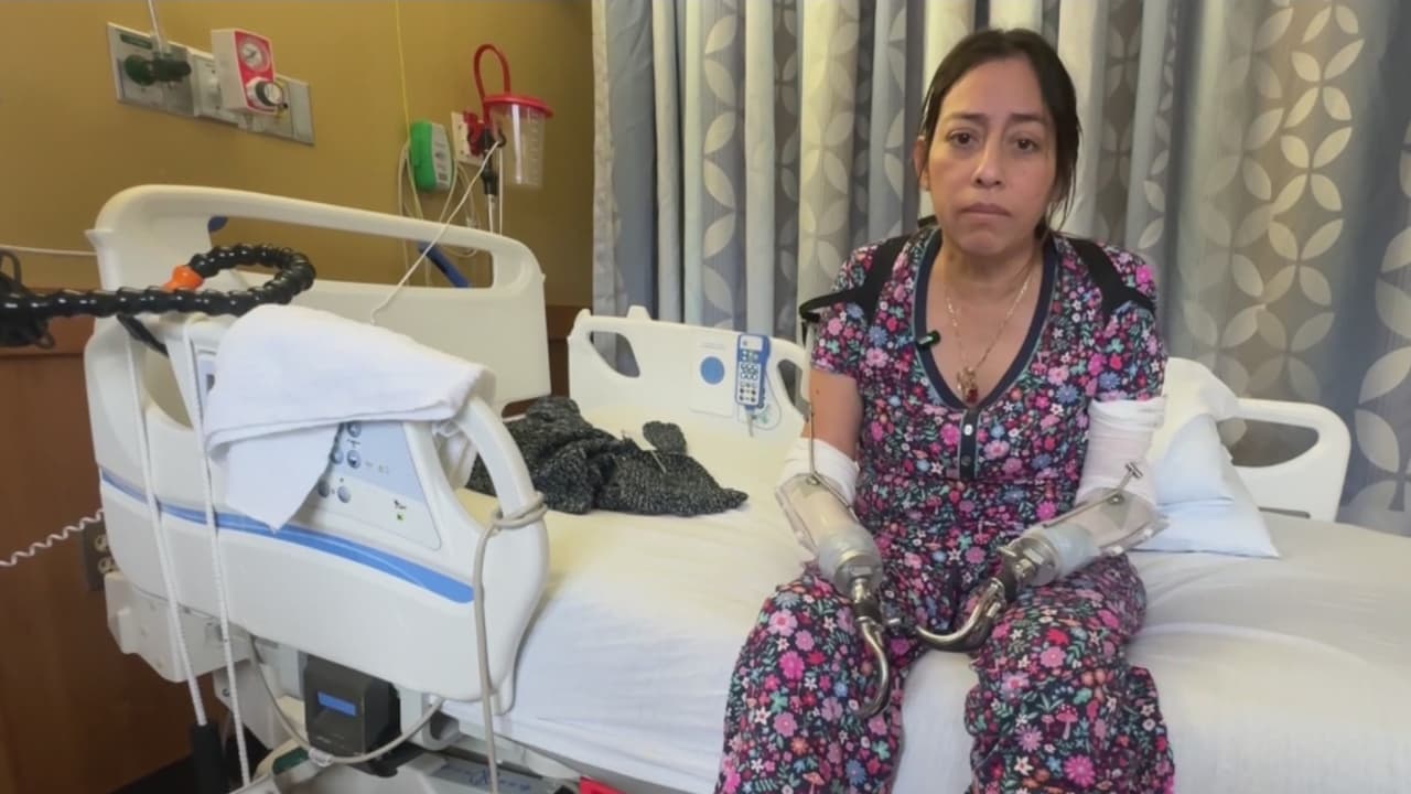 Tras perder manos y pies, hispana del DMV enfrenta un nuevo drama por estafas a su nombre