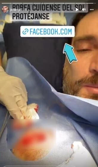 El actor de la telenovela ‘La herencia’ dijo que la manchita “le picaba un poquito”, así que el dermatólogo endocrinólogo le hizo una biopsia y descubrió que tenía cáncer de piel.
<br>