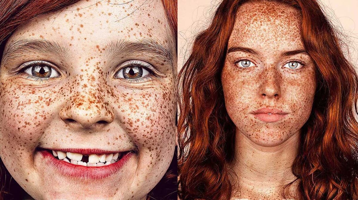 Recorrió el mundo para mostrar la belleza de las pecas.