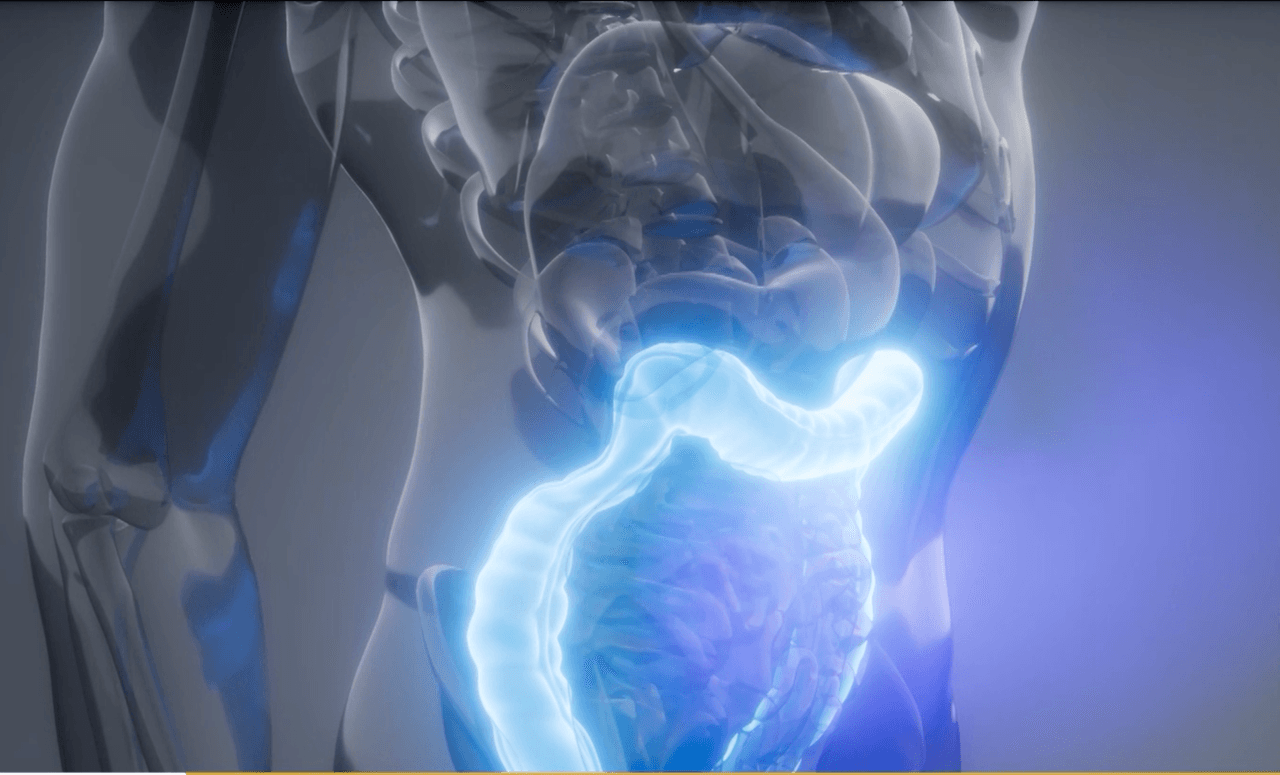 Lo que debes saber sobre el cáncer colorrectal