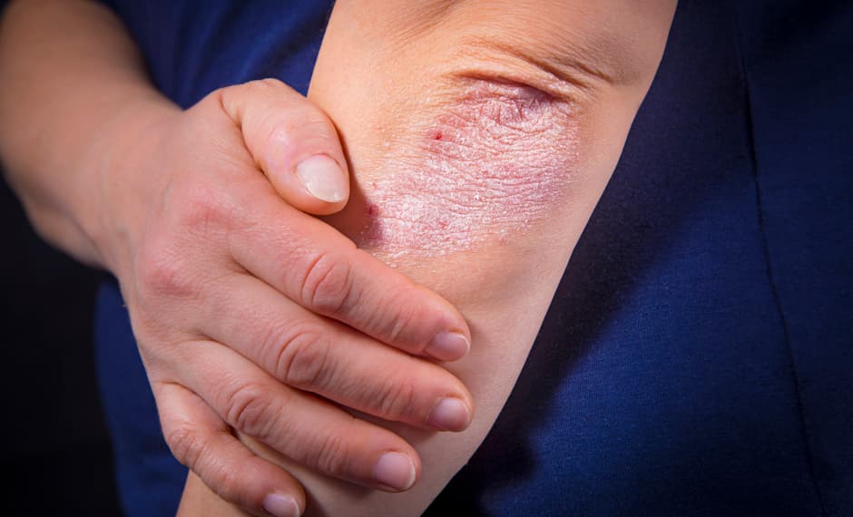 Este tipo de dermatitis es una inflamación en la piel que se manifiesta como una erupción cutánea que provoca picor, piel seca y agrietada, e incluso algunas veces hinchazón y dolor.