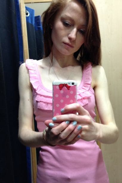 Ella es Nicola de tan sólo 18 años y quien sufrió de anorexia.