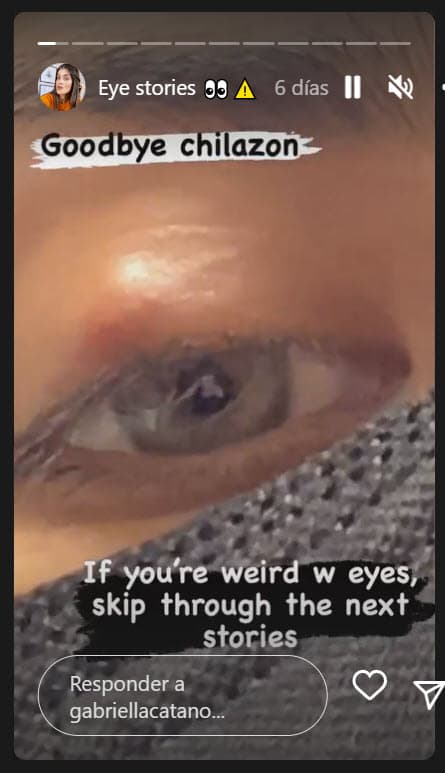 La joven experta en maquillaje reveló hace unos días que tendría que someterse a una cirugía en el ojo izquierdo para retirar una carnosidad, la cual en el argot médico se conoce como 
<b>chalazión. </b>
<br>