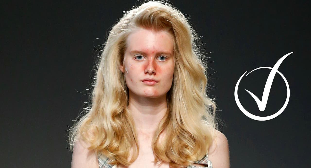 Está de moda tener acné (y por qué las pasarelas están haciendo de lo feo algo bello)