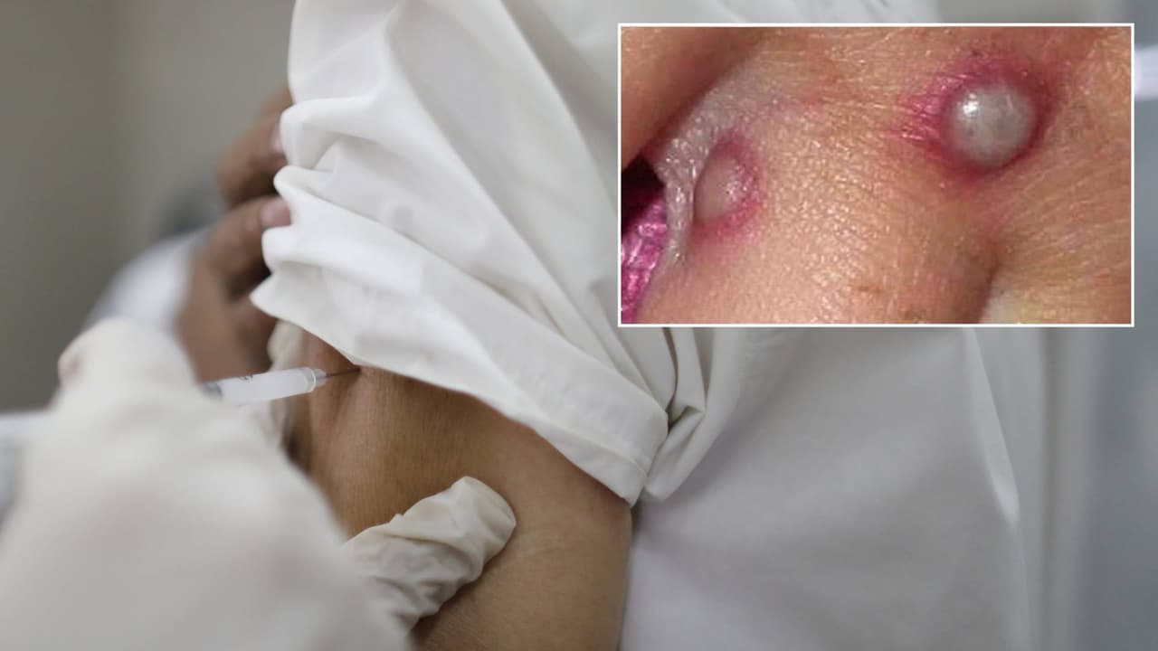 Nueva York reporta 490 casos de Viruela del Mono