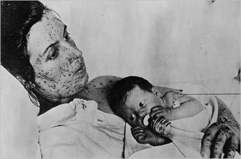 El cuadro clínico de la viruela símica se asemeja al de 
<b>la viruela</b>, enfermedad que causó millones de muertes en la historia pero quedó erradicada a nivel global en 1980. Ambas son infecciones por un virus del género Orthopoxvirus pero 
<b>la símica es menos contagiosa y causa una enfermedad menos grave</b>. Tanto para las vacunas como para el tratamiento de la viruela del mono se están aprovechando los que se desarrollaron para la viruela, una enfermedad que se ve reflejada en esta imagen de una madre infectada con su bebé.