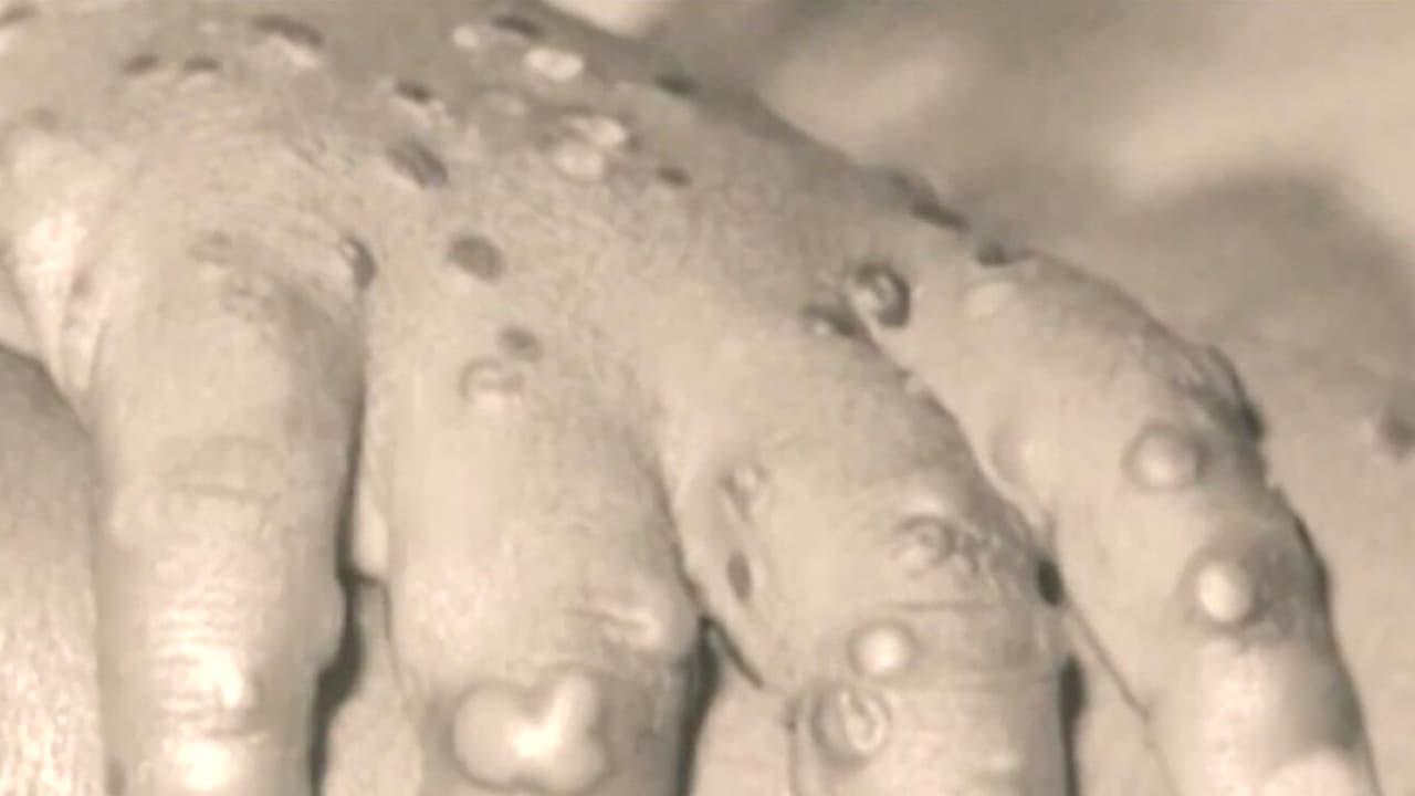 Si bien California declaró emergencia por el virus, la medida se aplicó para recibir más recursos federales para enfrentar los contagios. Por otra parte, las autoridades sanitarias no quieren estigmatizar la enfermedad a un grupo en particular.