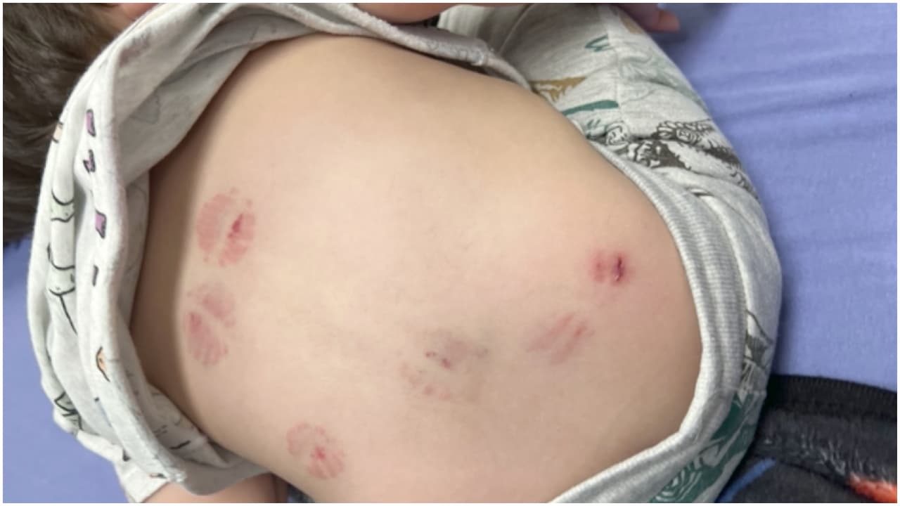 Una madre denuncia que su hijo recibió al menos seis mordidas en su cuerpo en una guardería
