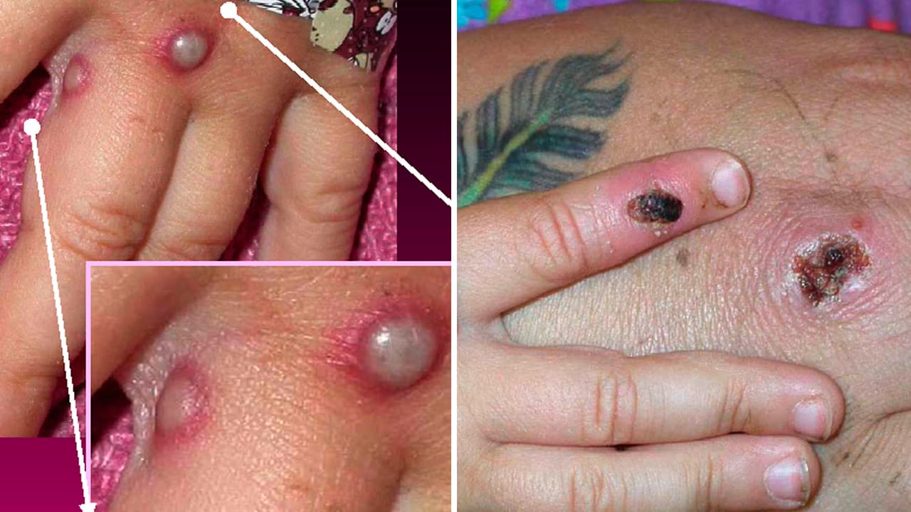 Experto médico habla del caso de viruela del mono confirmado en Texas y su eventual llegada a Houston