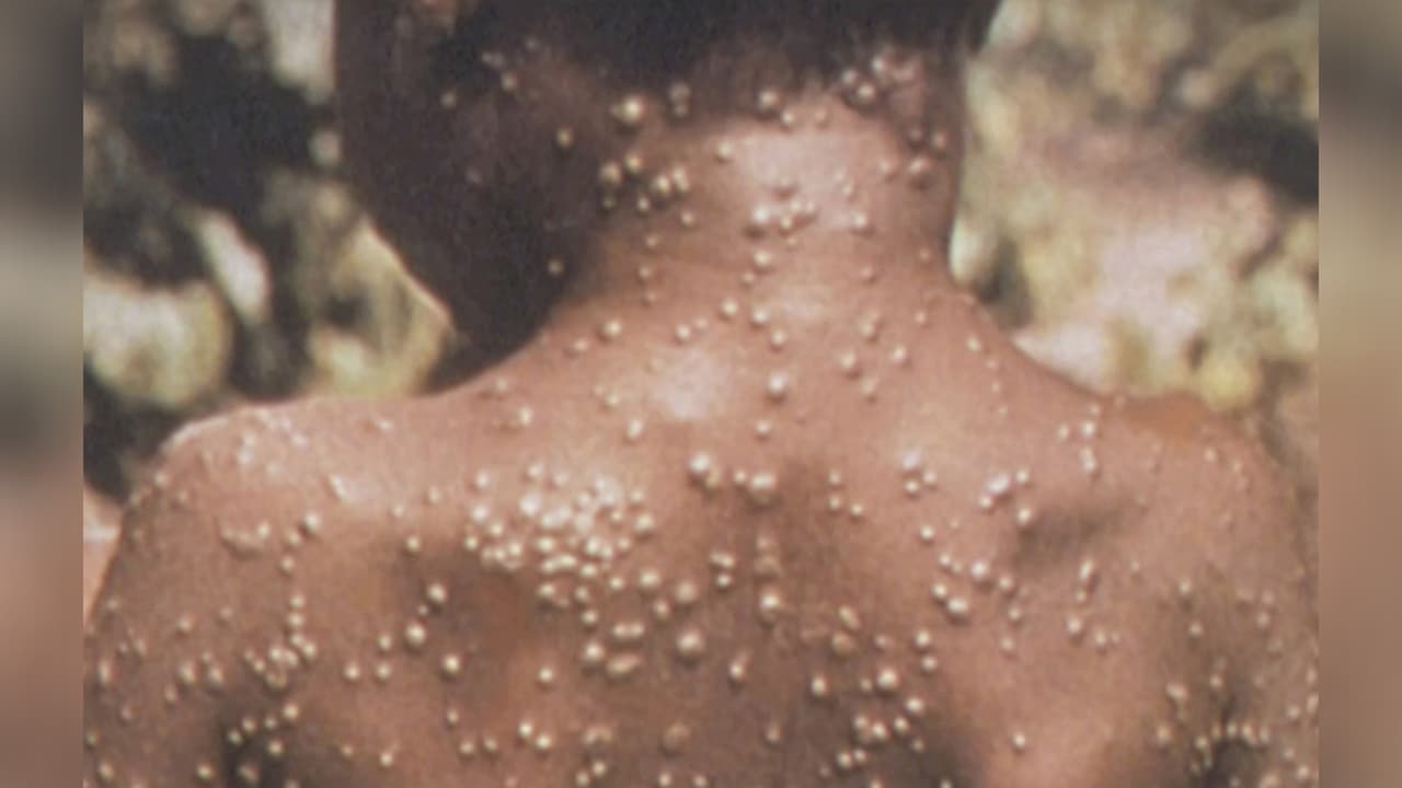 Esta tarde se abrirán citas para aplicarse la vacuna contra Viruela del Mono